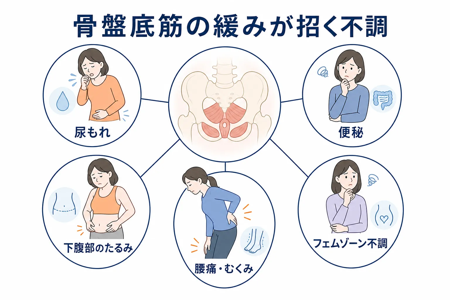 骨盤底筋の緩みが尿もれや便秘、腰痛など複数の不調につながる関係を示す図