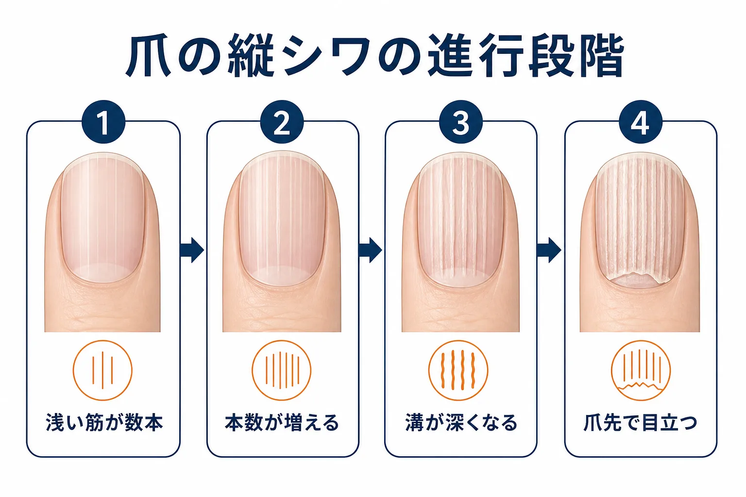 浅い筋から始まり本数が増え、溝が深くなっていく爪の縦シワの進行段階を示す図