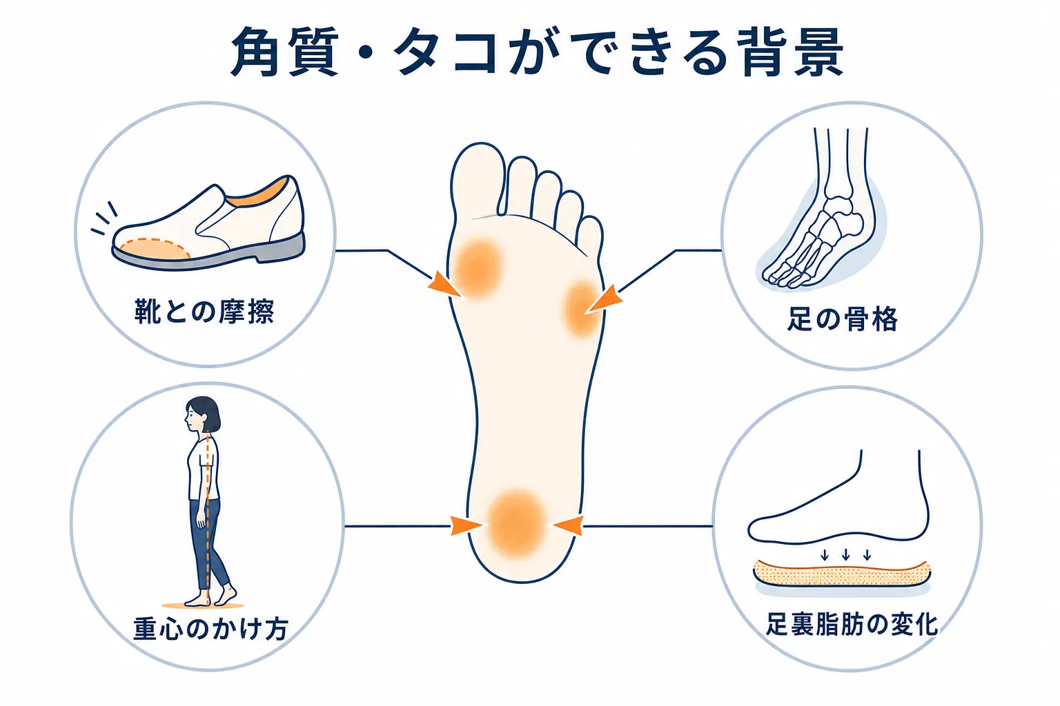 靴との摩擦や重心のかけ方など、角質やタコができやすくなる背景要因を示した図