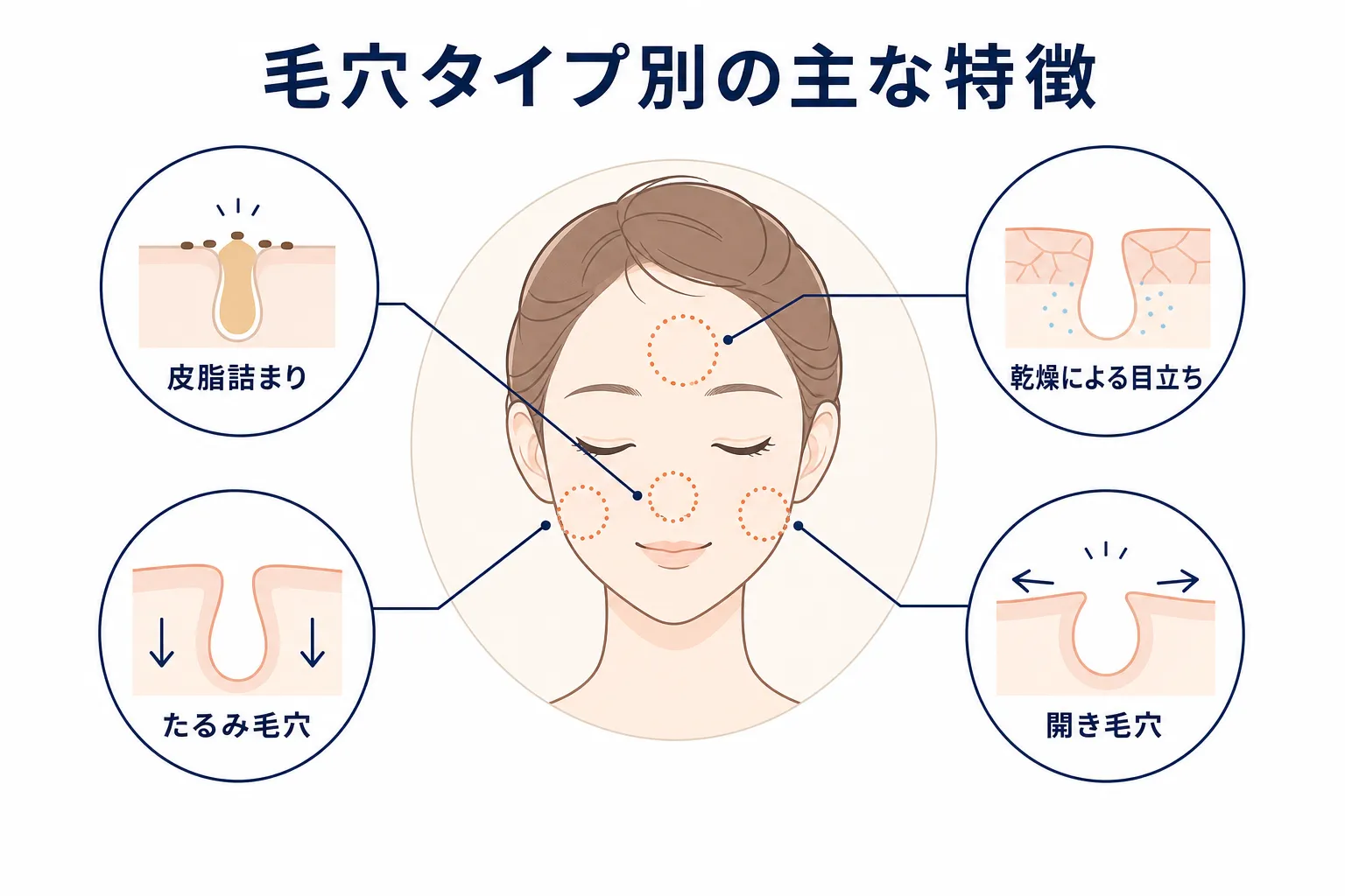 皮脂詰まり、乾燥、たるみ、開きという4つの毛穴タイプを示した図